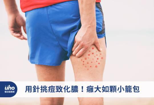 用針挑痘致化膿!癰大如顆小籠包