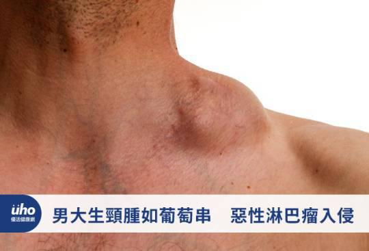 男大生頸腫如葡萄串 惡性淋巴瘤入侵