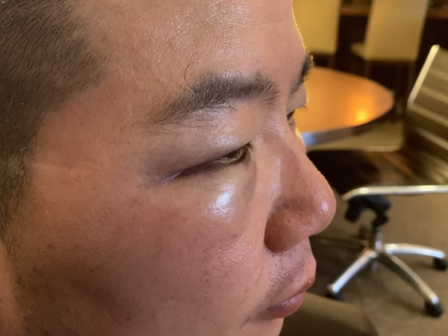 華裔家庭日前在法拉盛遭非洲裔侮辱、攻擊、性騷擾、砸車,華裔父親臉部被揍多拳,右眼瘀青腫漲嚴重。(來源:美國《世界日報》記者賴蕙榆 攝 )
