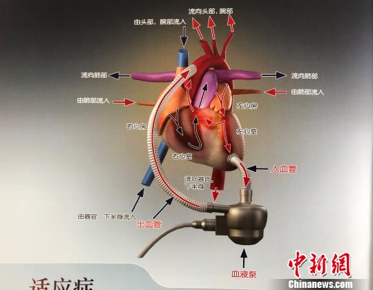 圖爲“永仁心”人工心臟工作原理示意圖(翻拍自資料)。 鍾欣 攝